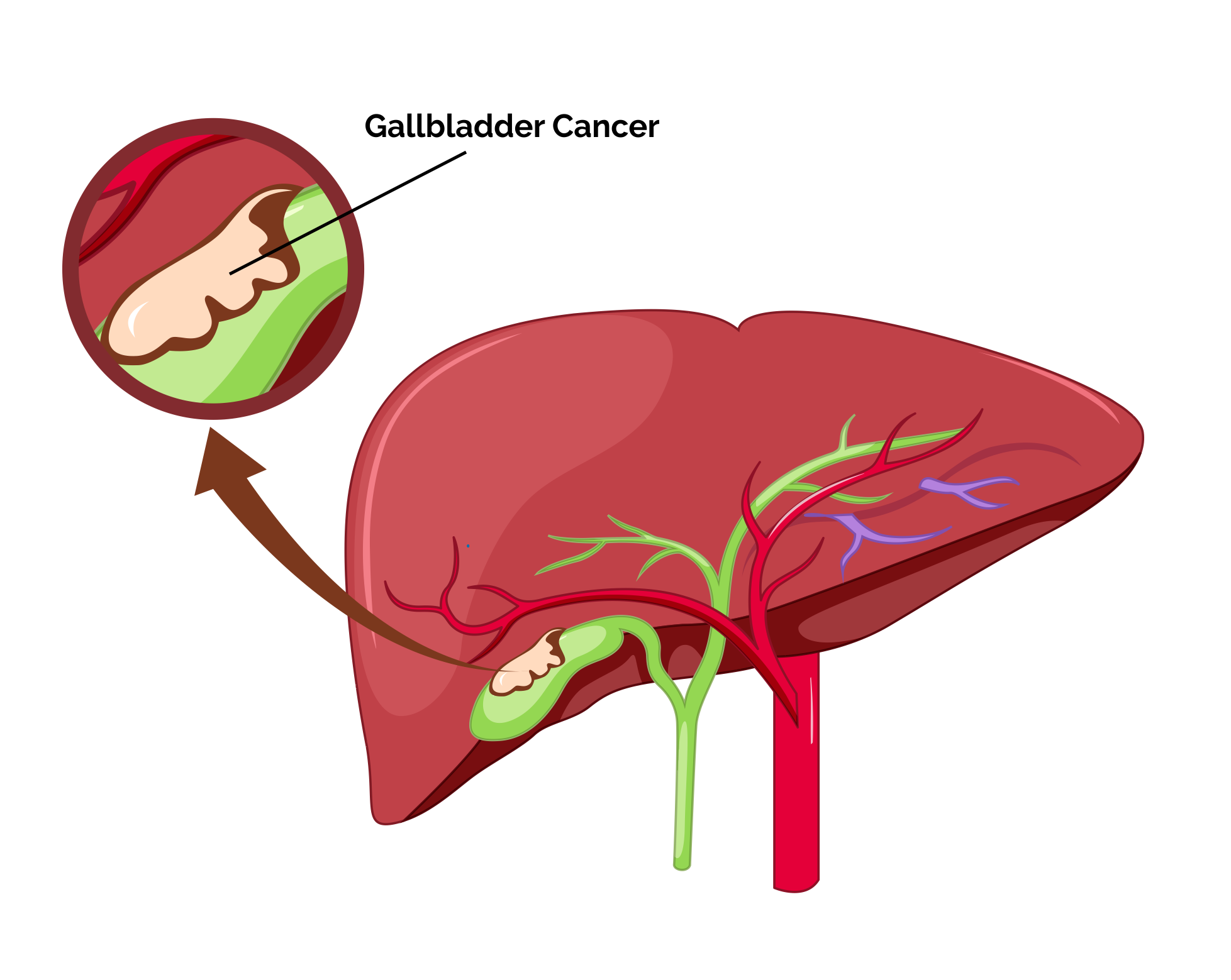 Gallbladder Cancer 
