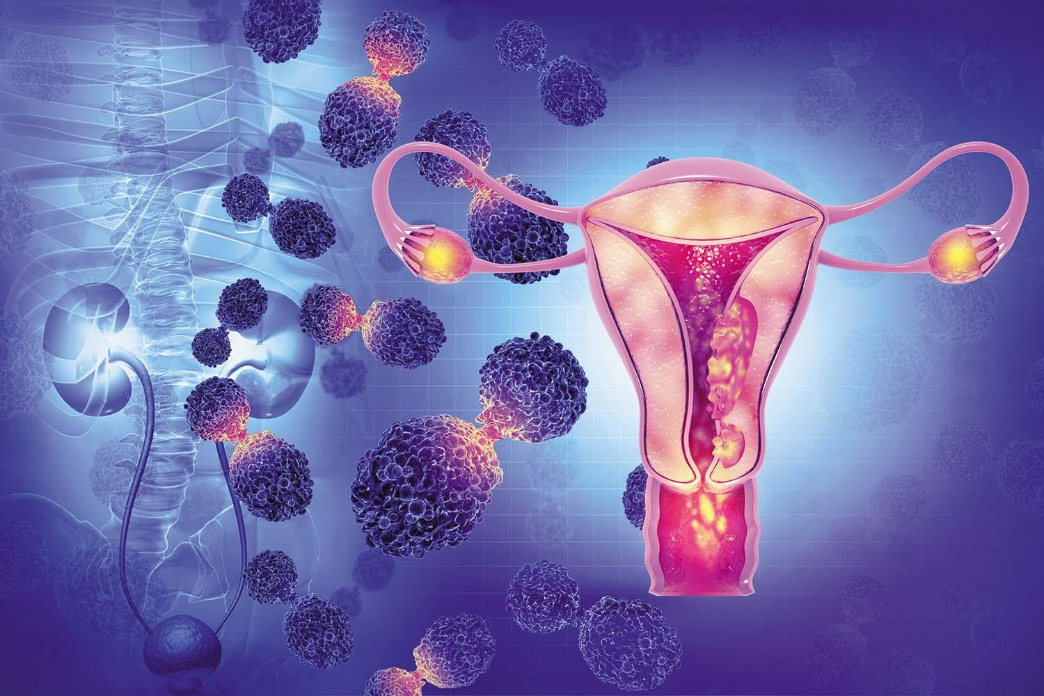 Gynecological Cancer 