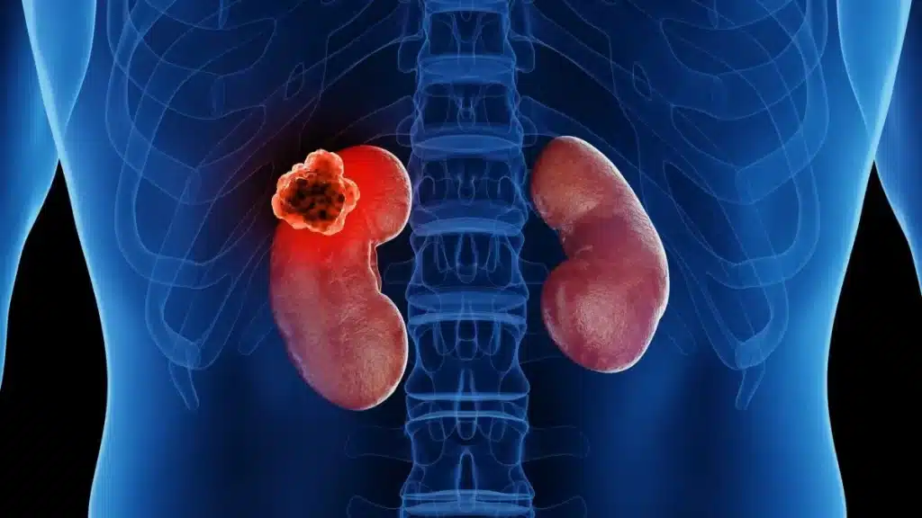 Kidney Cancer 
