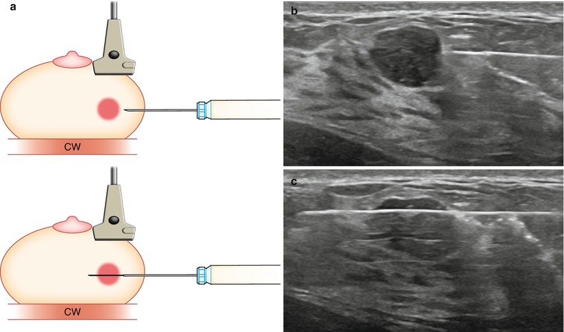Ultrasound guided core needle biopsy of the breast lump
