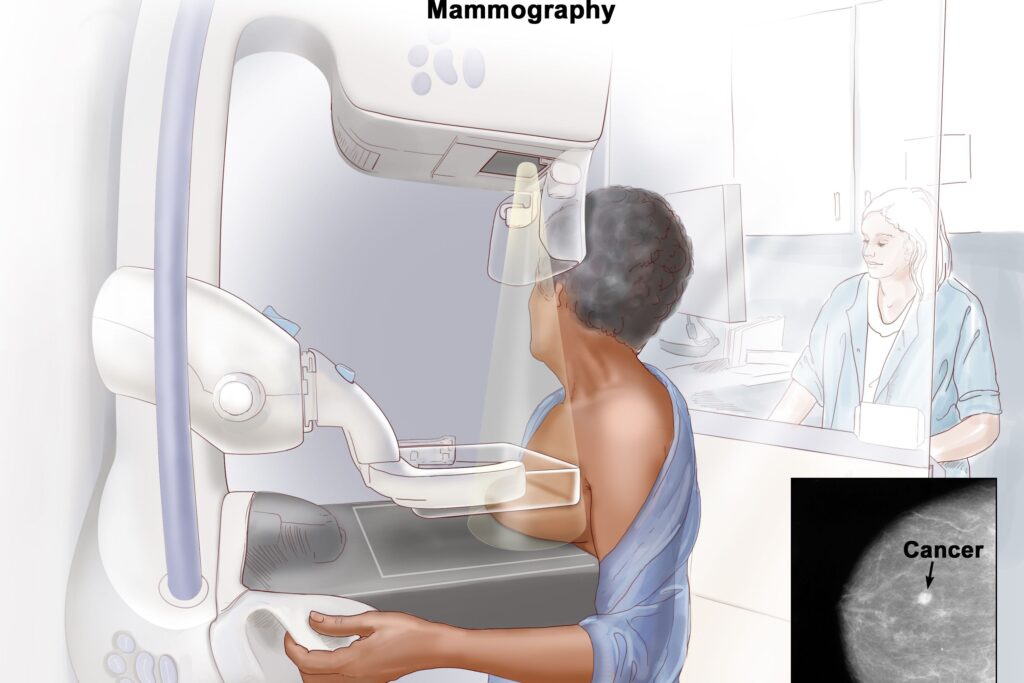 Mammogram